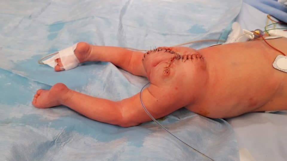 Lékaři v Podolí operovali nenarozenému dítěti obří nádor